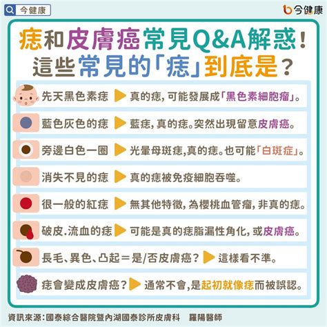 臉頰長痣代表什麼|是痣or皮膚癌？醫「1張圖秒對照」 長這2部位最危險